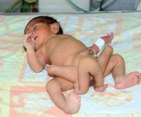 Nace un bebé con seis piernas en Pakistán