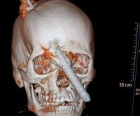 Una tomografía que muestra cómo el cráneo de Eduardo Leite fue atravesado por la barra.